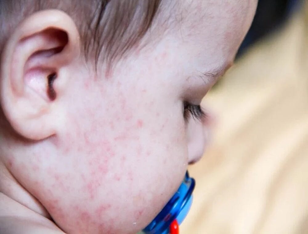 La lessive est-elle responsable des allergies de bébé ?